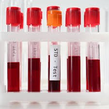 STD 7 Panel (Real Time PCR)-Chlamydia Trachomatis, Mycoplasma Genitalium,Treponema Pallidum,Ureaplasma Urealyticum,Mycoplasma Hominis, HSV I&II