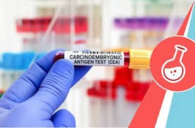 Carcino Embryonic Antigen (CEA) Test – Reliable Cancer Biomarker for Early Detection & Monitoring | Serum-Based Chemiluminescence & ELFA Methodology