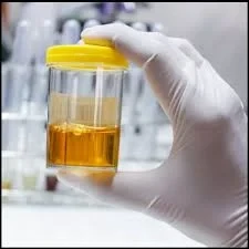 تحليل Porphobilinogen النوعي (بول عشوائي)