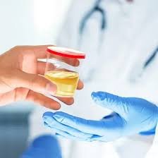 Porphyrins Qualitative Test (Random Urine)