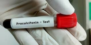 Procalcitonin (PCT) Test