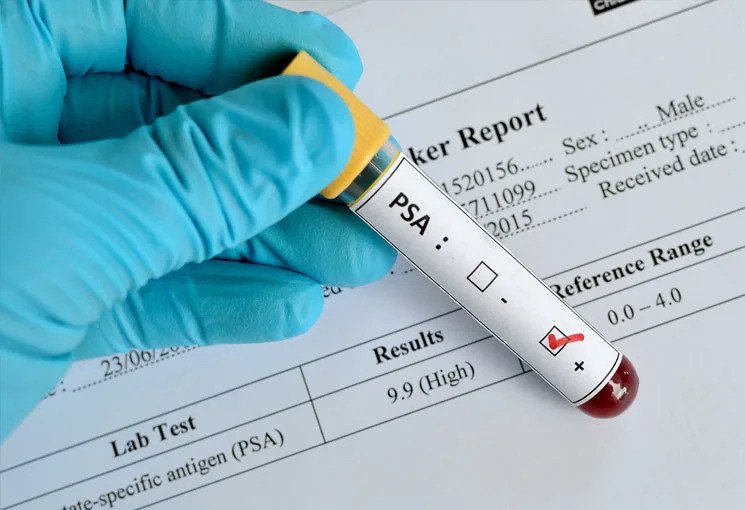 Prostatic Specific Antigen (PSA) Ratio Test