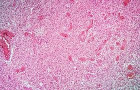NGS CNS/Glioma Molecular Panel