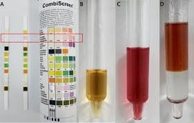 Urobilinogen (Random Urine) Test – Accurate Liver Function Analysis with 1-Day TAT | Non-Invasive Dipstick Method