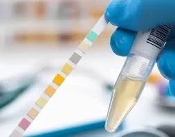 الكيتونات في البول العشوائي (Ketones - Random Urine Test)