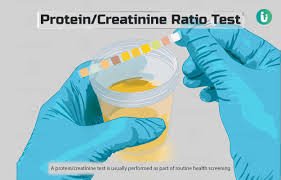 Protein/Creatinine Ratio Test (Random Urine)