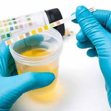 Random Urine Sodium (Na) Test