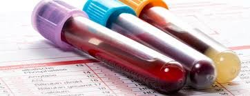 Protein S – Total Plasma Test