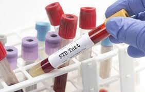 Sexual Transmitted Infection with HIV Test