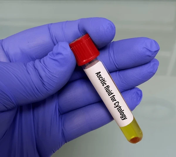 Protein Total - Ascitic Fluid Test