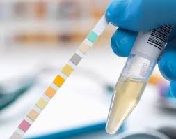 Ketones (Random Urine) Test