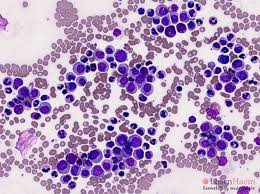 Oncomine Chronic myeloid leukaemia (CML) panel