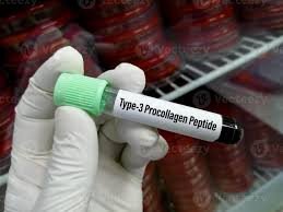 Procollagen Type III Peptide Serum Test