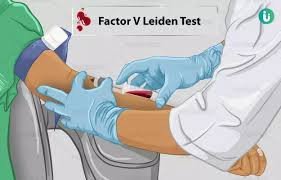 Factor V Leiden Mutation Analysis